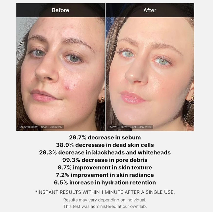 Medicube Red Acne Succinic Acid Peel 40g